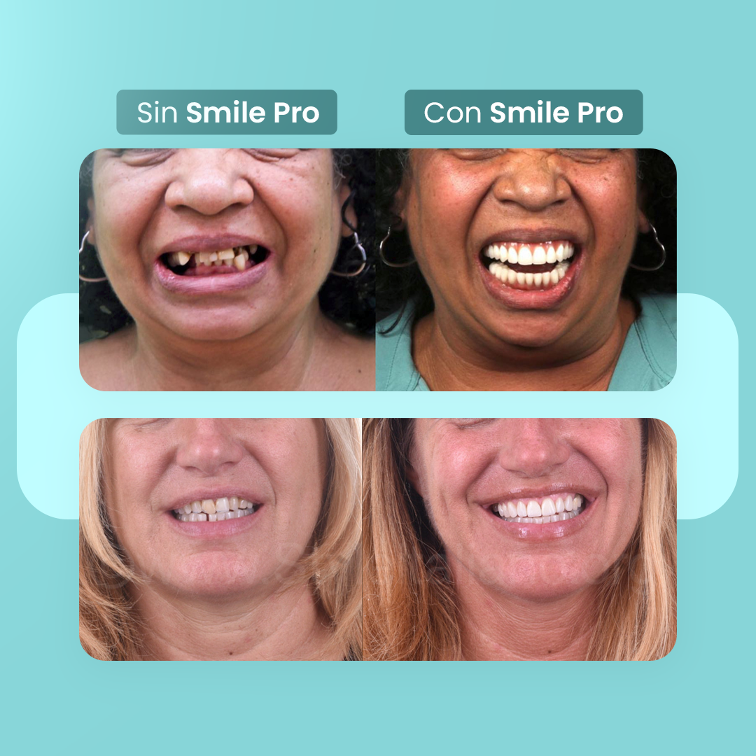 [COMPRÁ 1 Y LLEVÁ 2] Smile Pro® - Carillas Dentales Removibles | Inferior y Superior