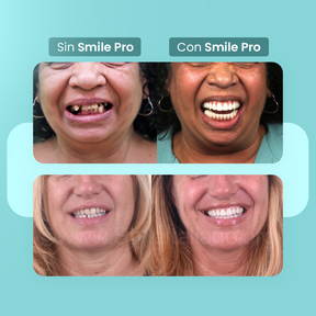 [COMPRÁ 1 Y LLEVÁ 2] Smile Pro® - Carillas Dentales Removibles | Inferior y Superior